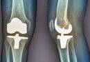Return to Sports Following Total Knee Arthroplasty