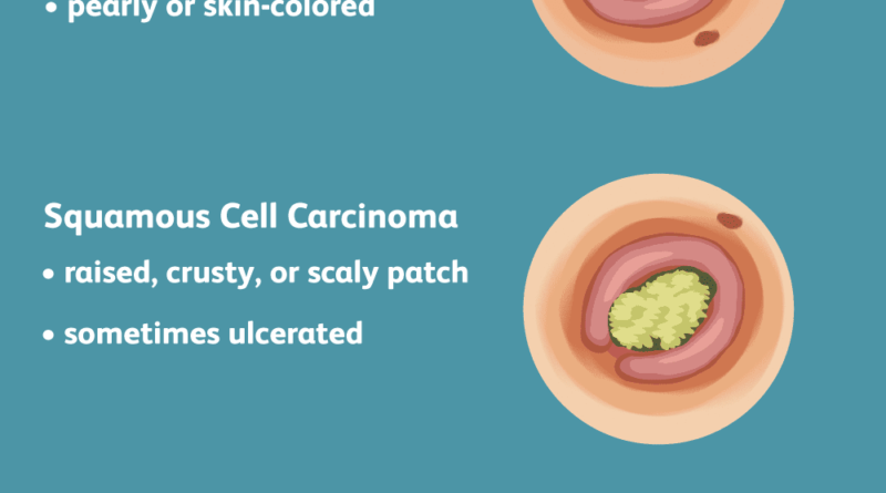 What is skin cancer and what causes it to occur?