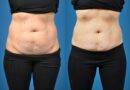 Frequently asked questions about body contouring or body sculpting